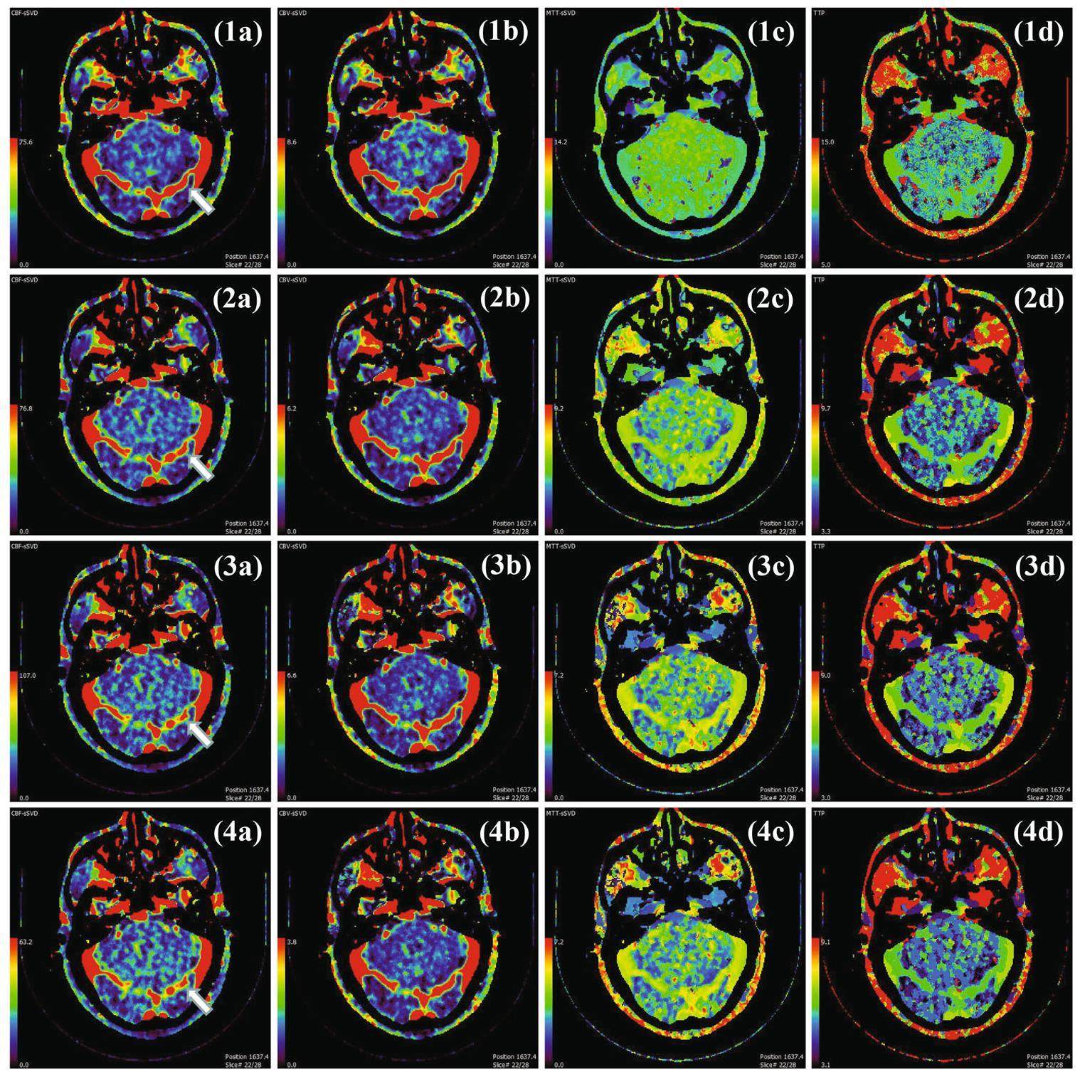 Rollback reconstruction for TDC enhanced perfusion imaging
