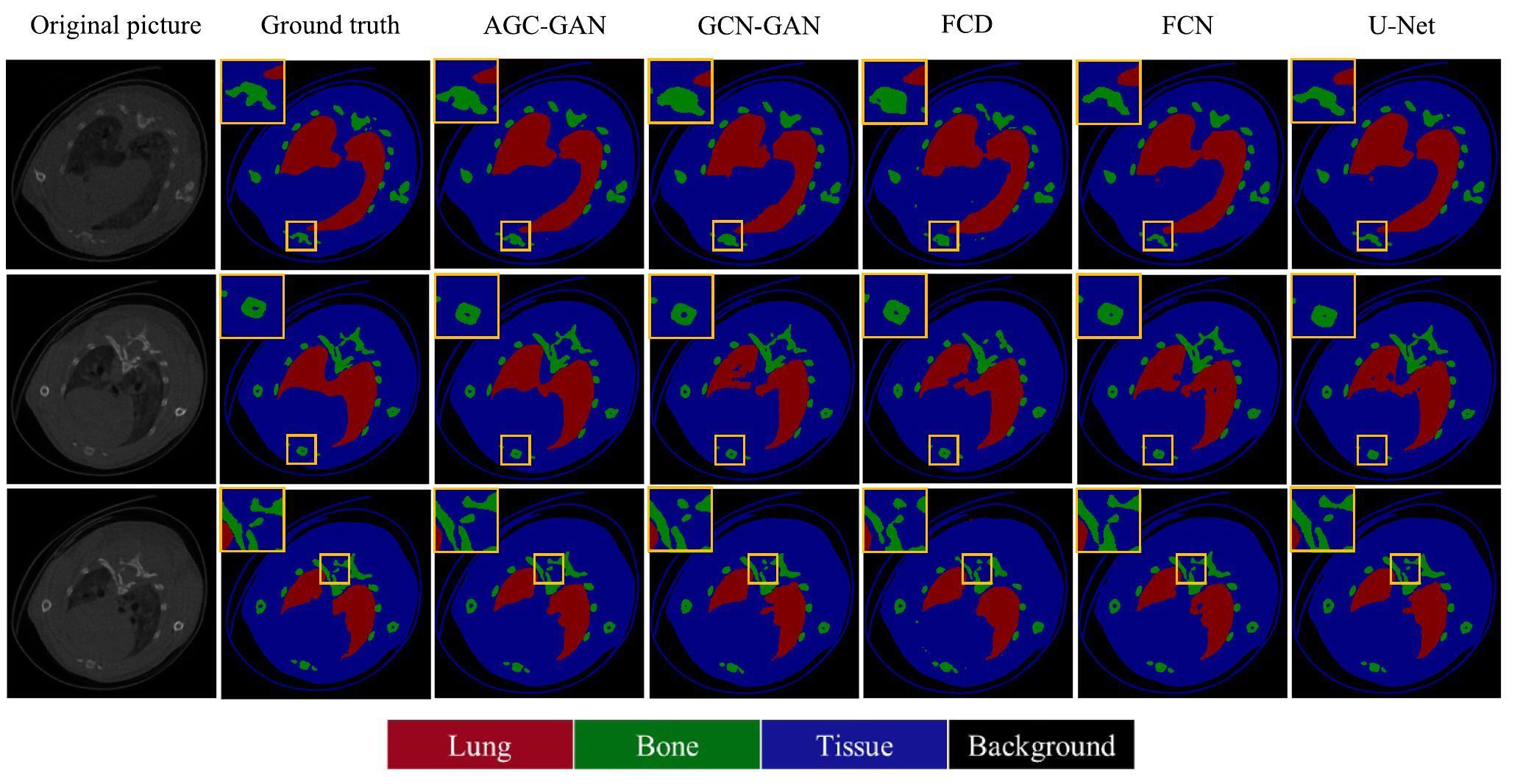 Material decomposition of spectral CT images via attention-based global ...