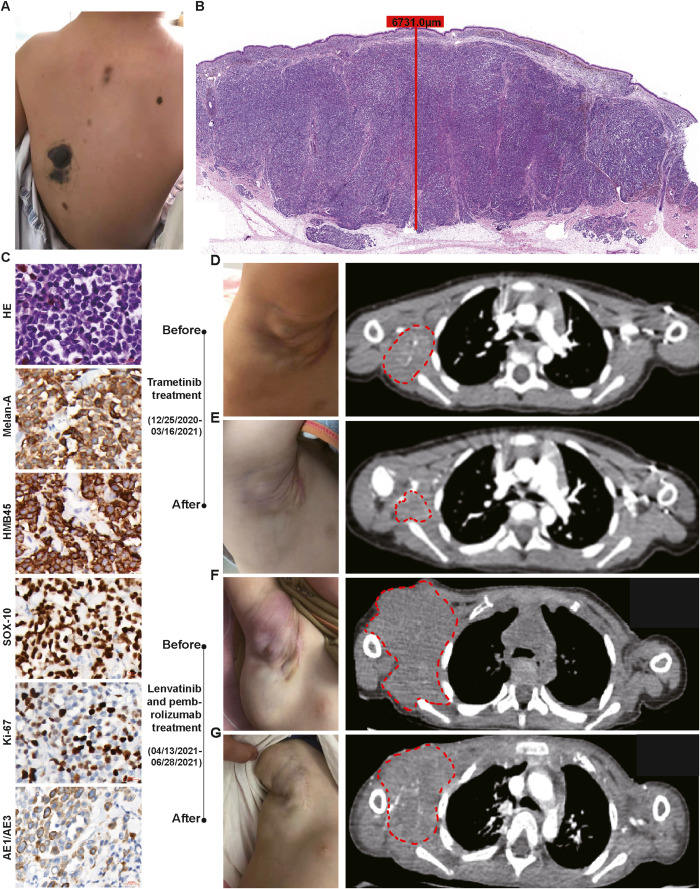 Clinical management of a rare melanoma case arising from congenital ...